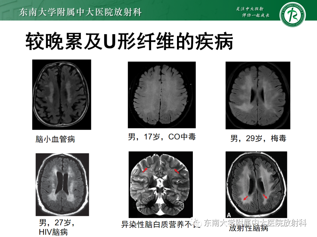 【PPT】皮层下U形纤维受累常见病变-31