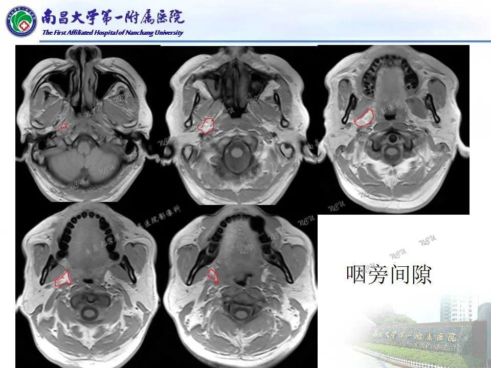 【PPT】咽旁间隙——你别动-8