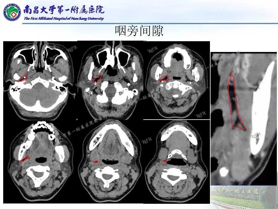 【PPT】咽旁间隙——你别动-7