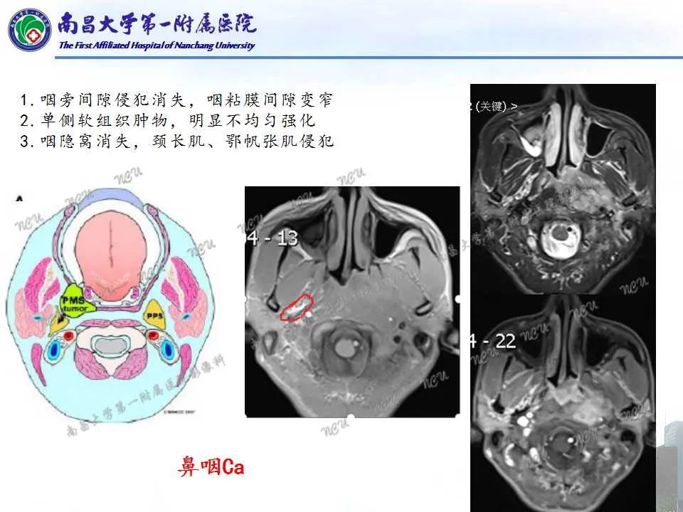 【PPT】咽旁间隙——你别动-16