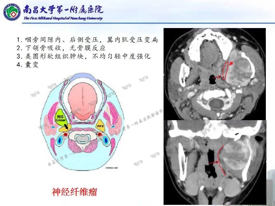 【PPT】咽旁间隙——你别动-17