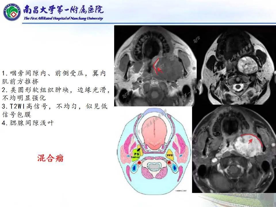 【PPT】咽旁间隙——你别动-18