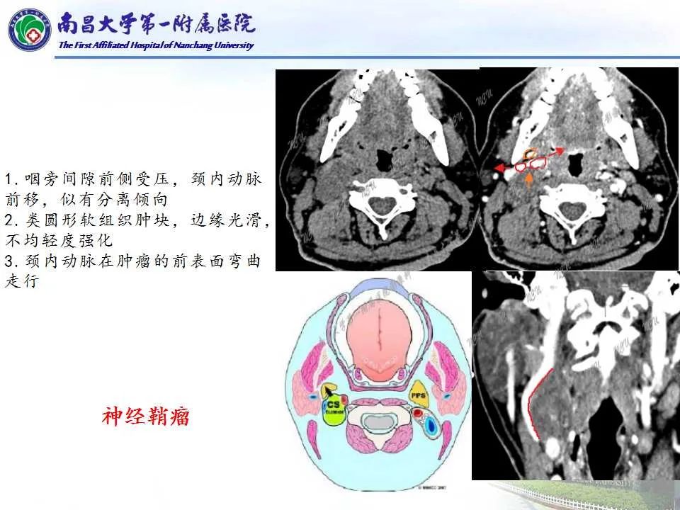 【PPT】咽旁间隙——你别动-19