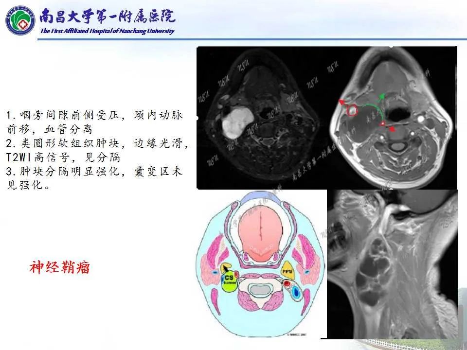 【PPT】咽旁间隙——你别动-20