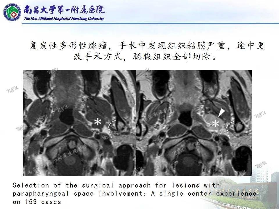 【PPT】咽旁间隙——你别动-28