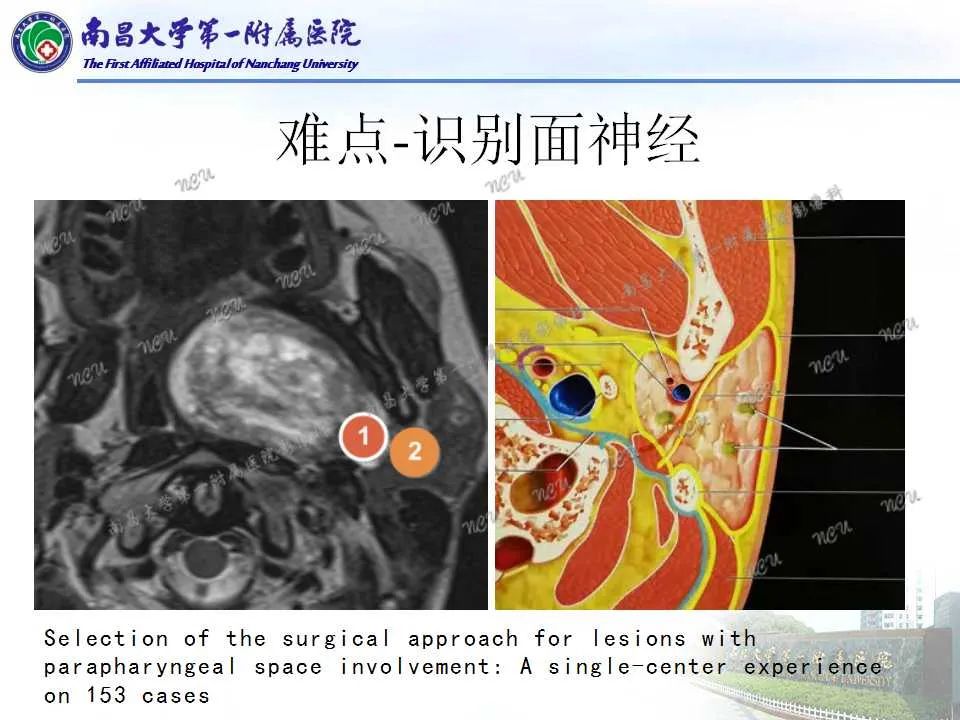 【PPT】咽旁间隙——你别动-29