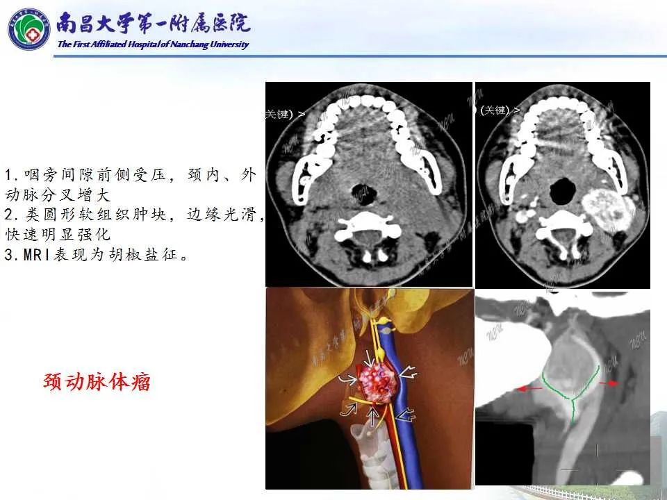 【PPT】咽旁间隙——你别动-21