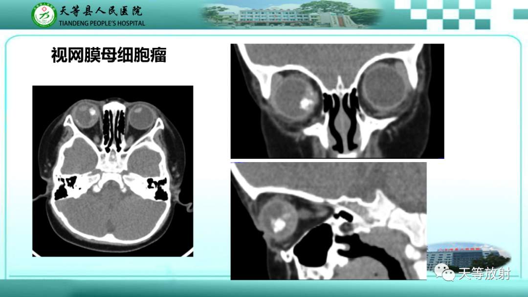 【PPT】眼眶分区及各分区常见疾病-12