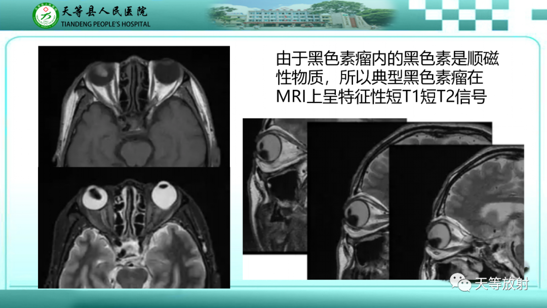 【PPT】眼眶分区及各分区常见疾病-14