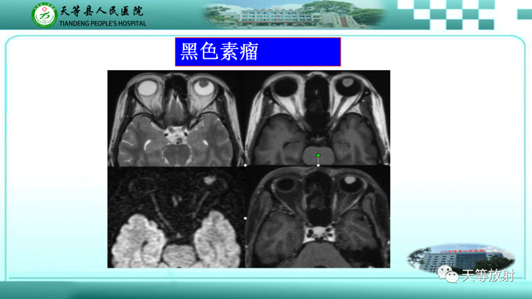 【PPT】眼眶分区及各分区常见疾病-15