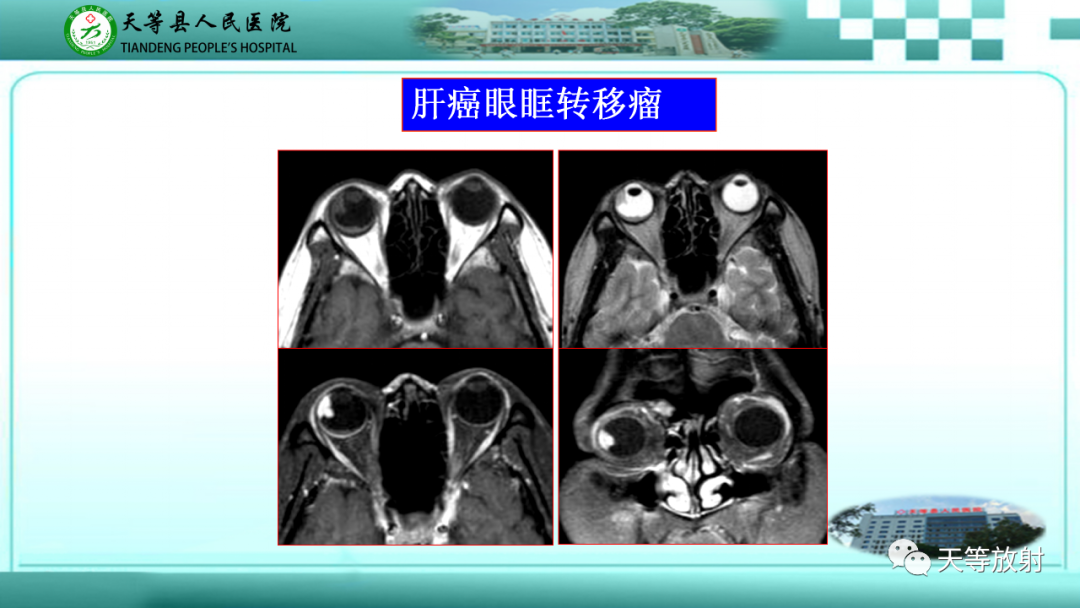 【PPT】眼眶分区及各分区常见疾病-16