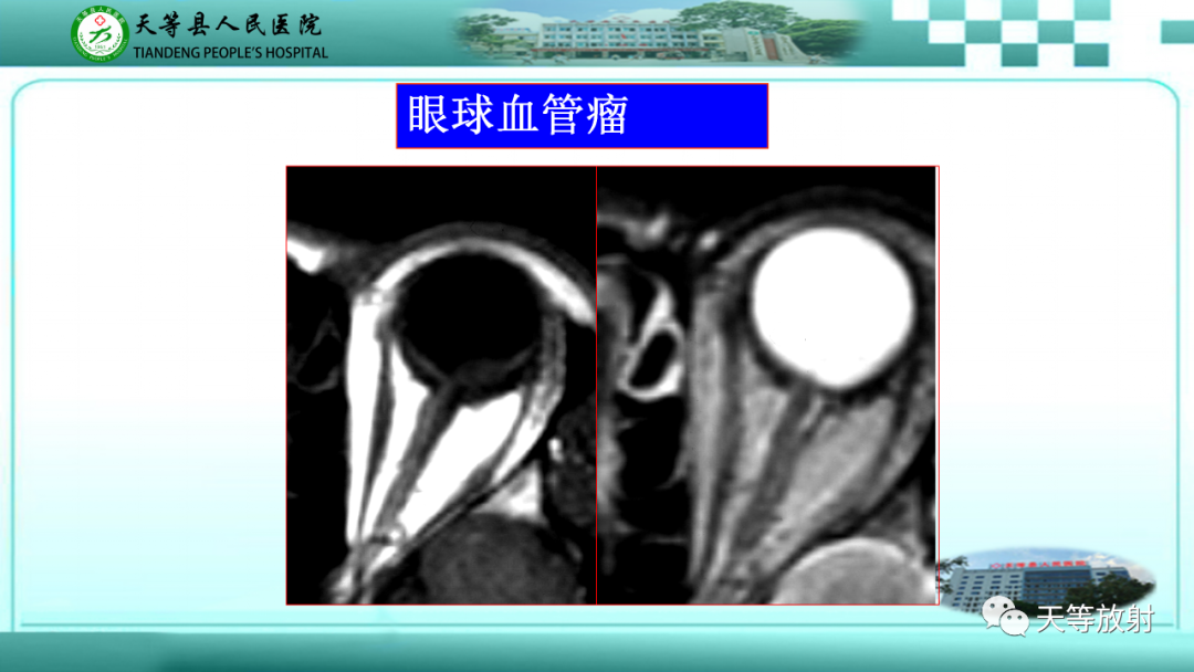 【PPT】眼眶分区及各分区常见疾病-18