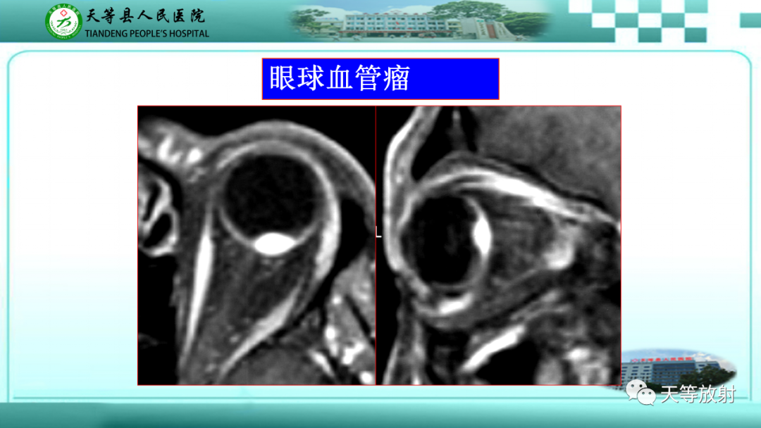 【PPT】眼眶分区及各分区常见疾病-19