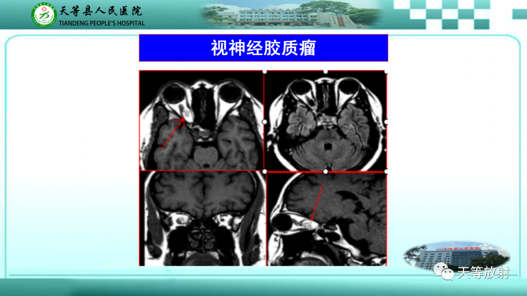 【PPT】眼眶分区及各分区常见疾病-21