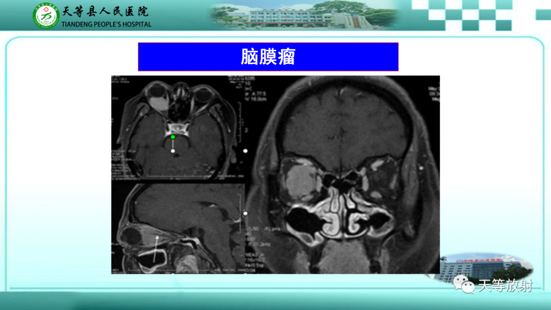 【PPT】眼眶分区及各分区常见疾病-22