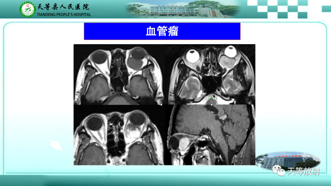 【PPT】眼眶分区及各分区常见疾病-25