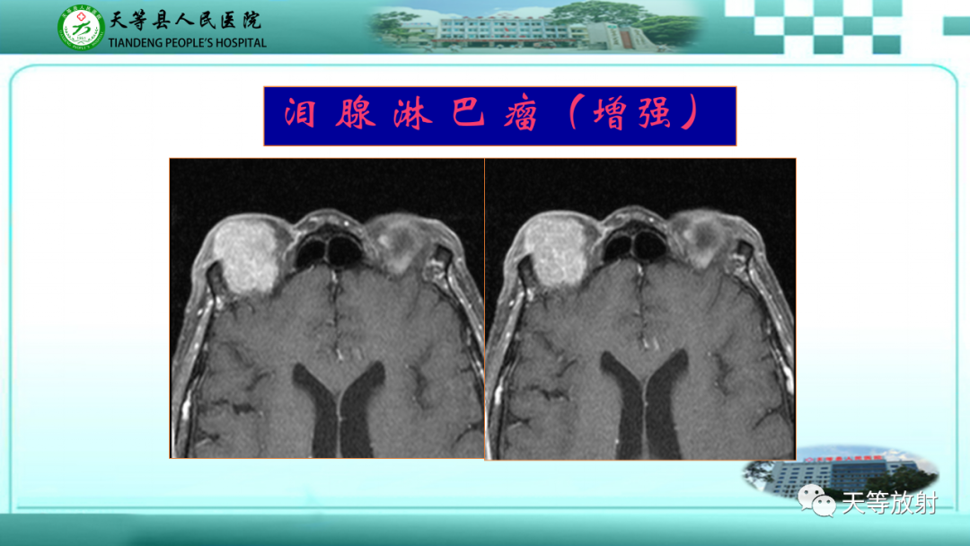 【PPT】眼眶分区及各分区常见疾病-35