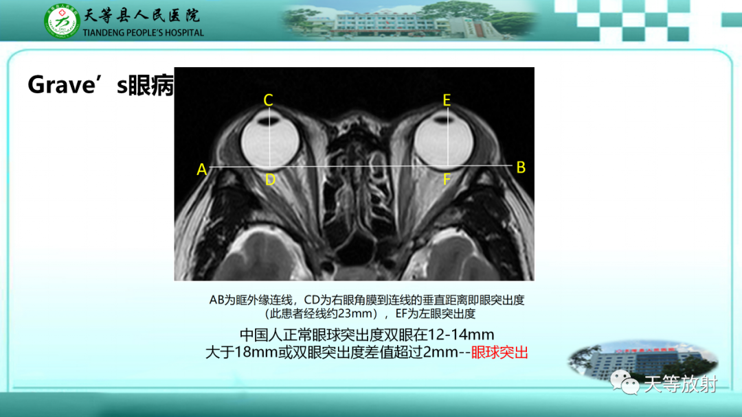 【PPT】眼眶分区及各分区常见疾病-42