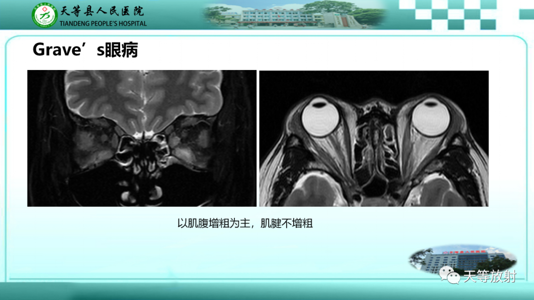 【PPT】眼眶分区及各分区常见疾病-43