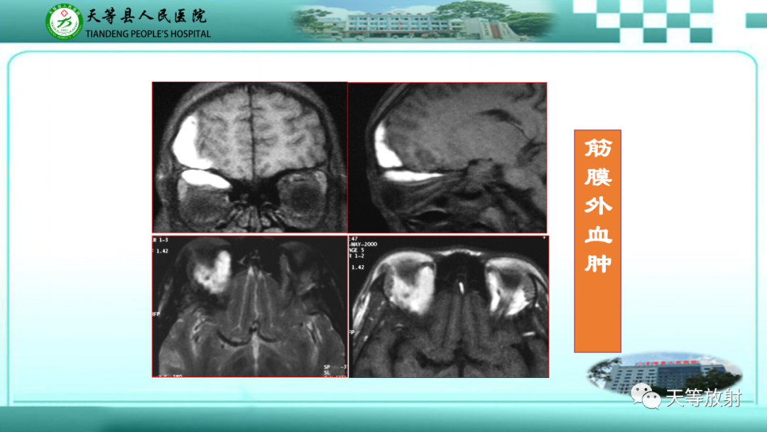 【PPT】眼眶分区及各分区常见疾病-46