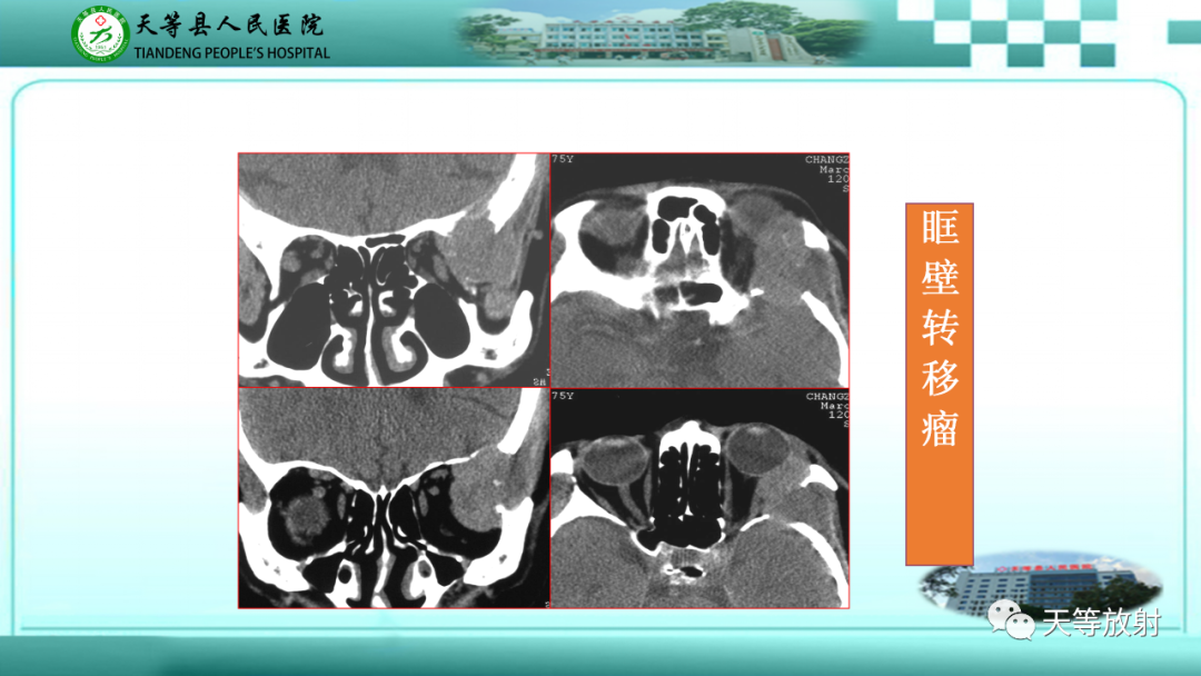 【PPT】眼眶分区及各分区常见疾病-47