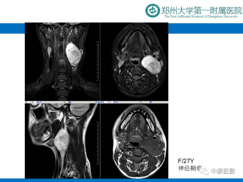 【PPT】颈部神经源性肿瘤的磁共振成像-12