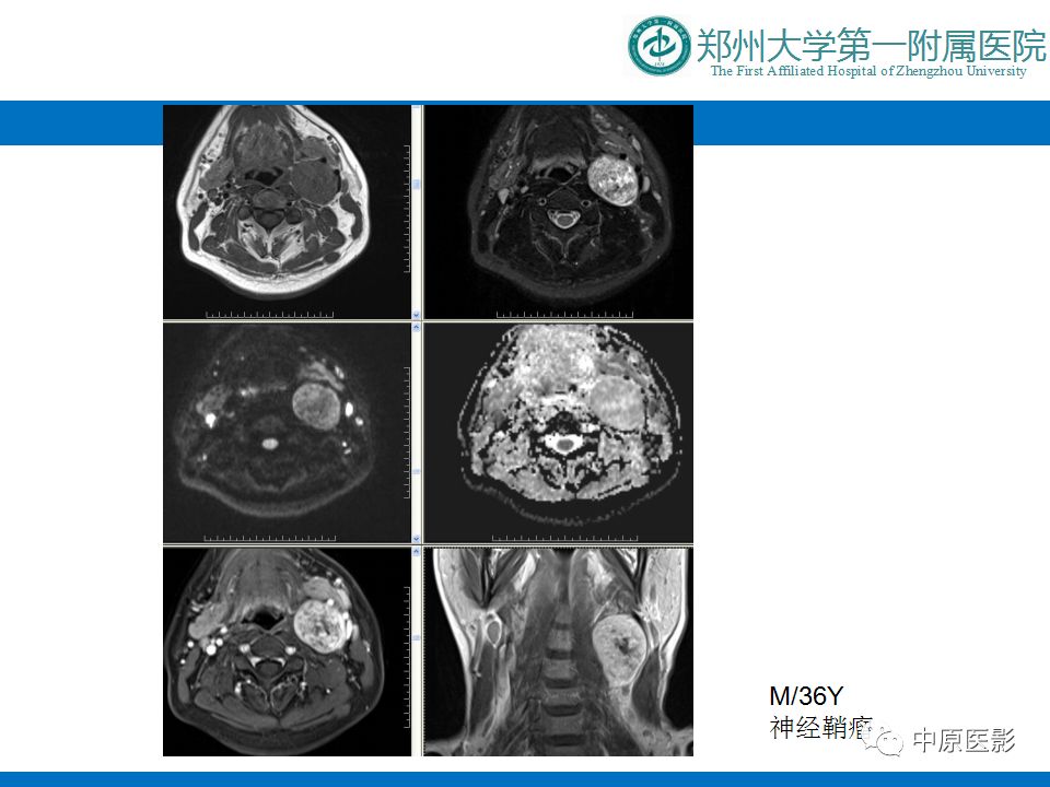 【PPT】颈部神经源性肿瘤的磁共振成像-11