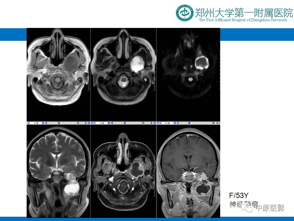 【PPT】颈部神经源性肿瘤的磁共振成像-13