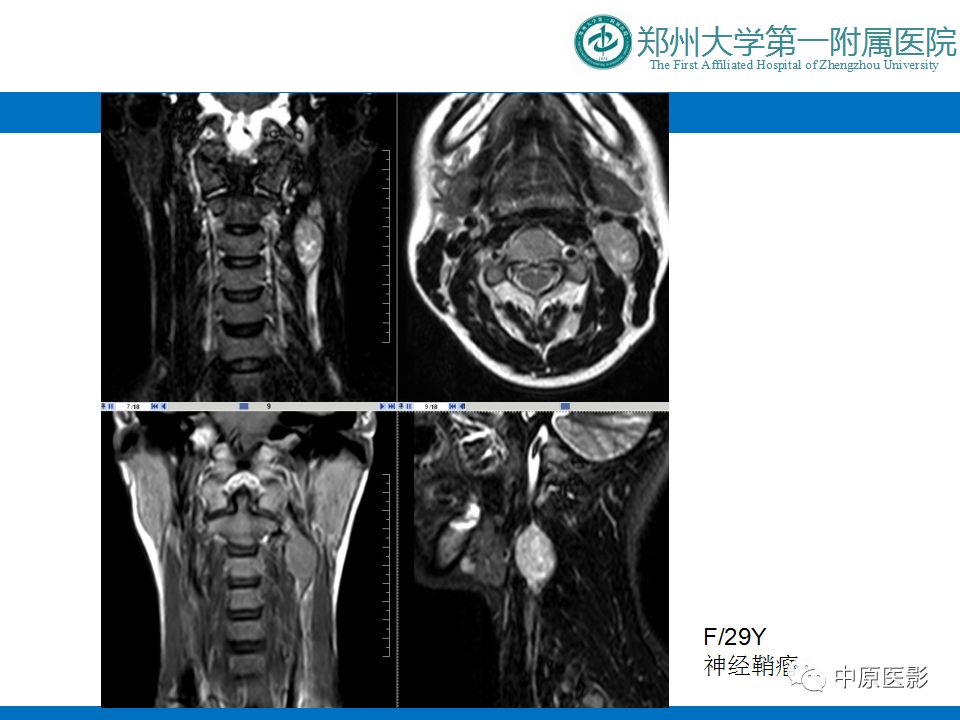 【PPT】颈部神经源性肿瘤的磁共振成像-15