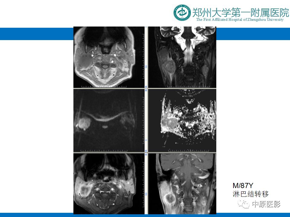 【PPT】颈部神经源性肿瘤的磁共振成像-19