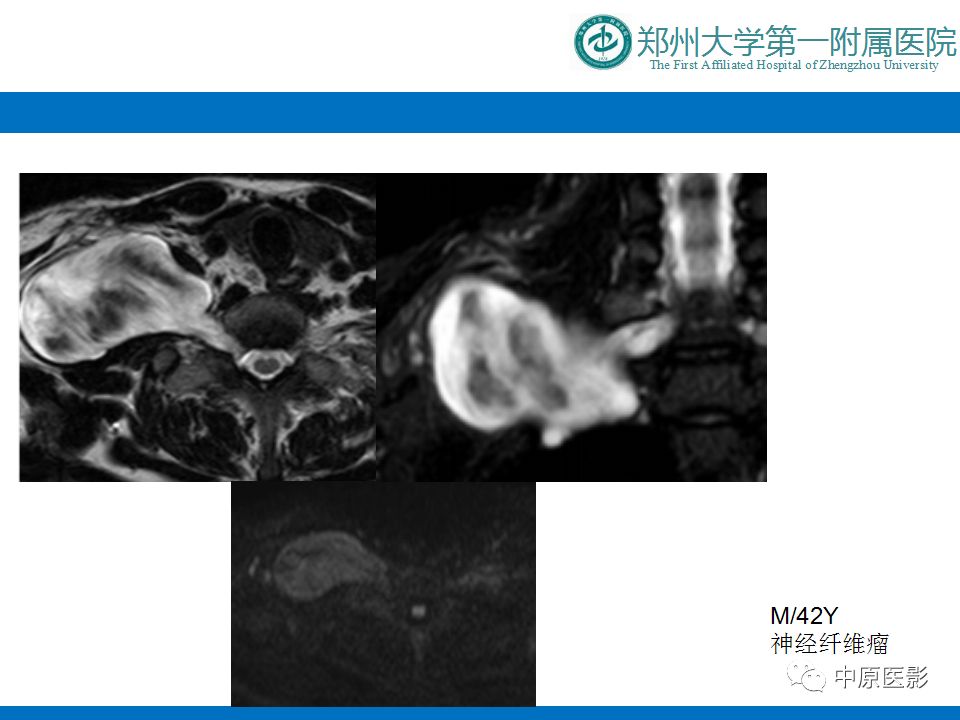 【PPT】颈部神经源性肿瘤的磁共振成像-28