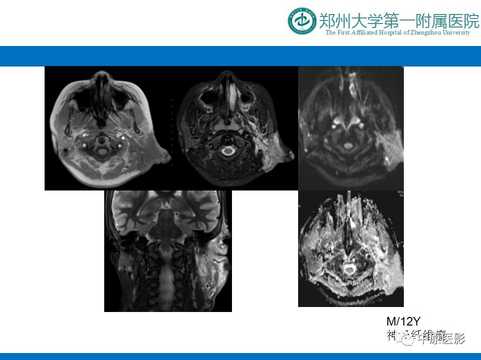 【PPT】颈部神经源性肿瘤的磁共振成像-27