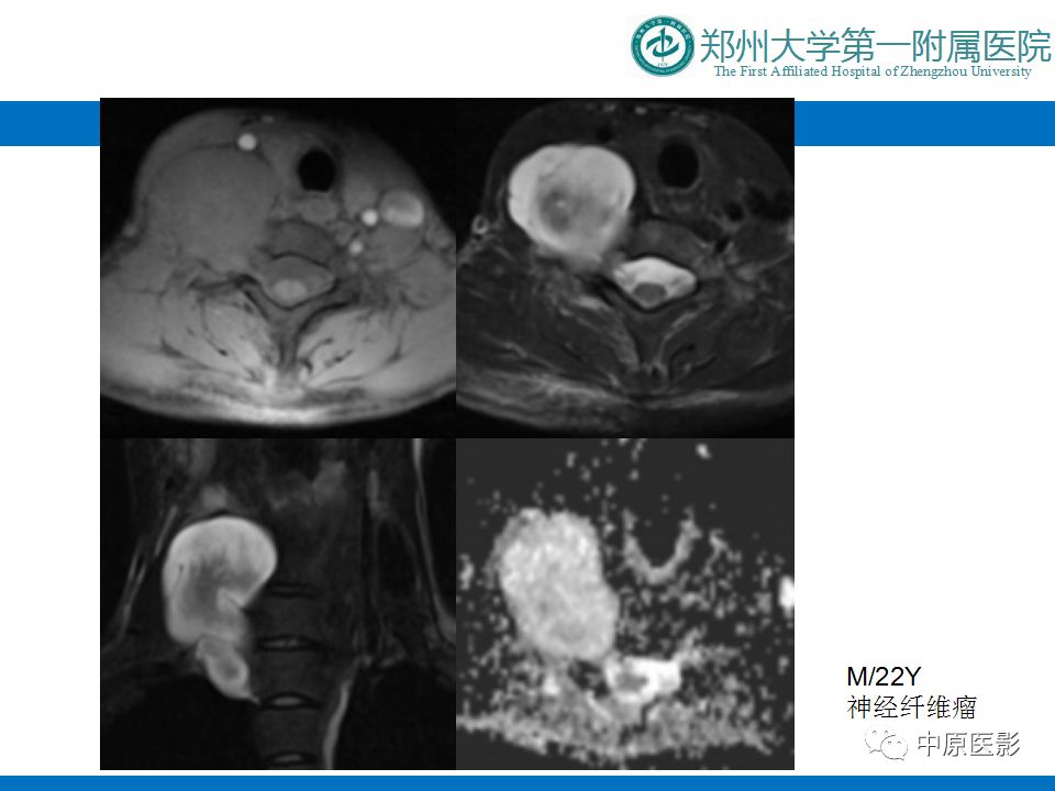 【PPT】颈部神经源性肿瘤的磁共振成像-29