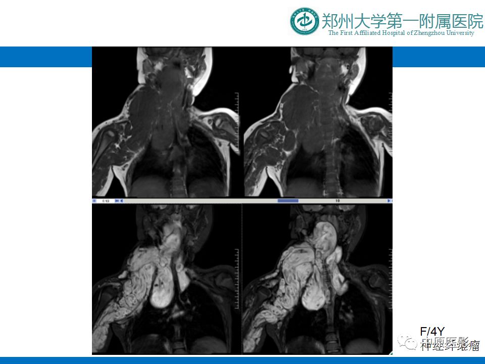 【PPT】颈部神经源性肿瘤的磁共振成像-31