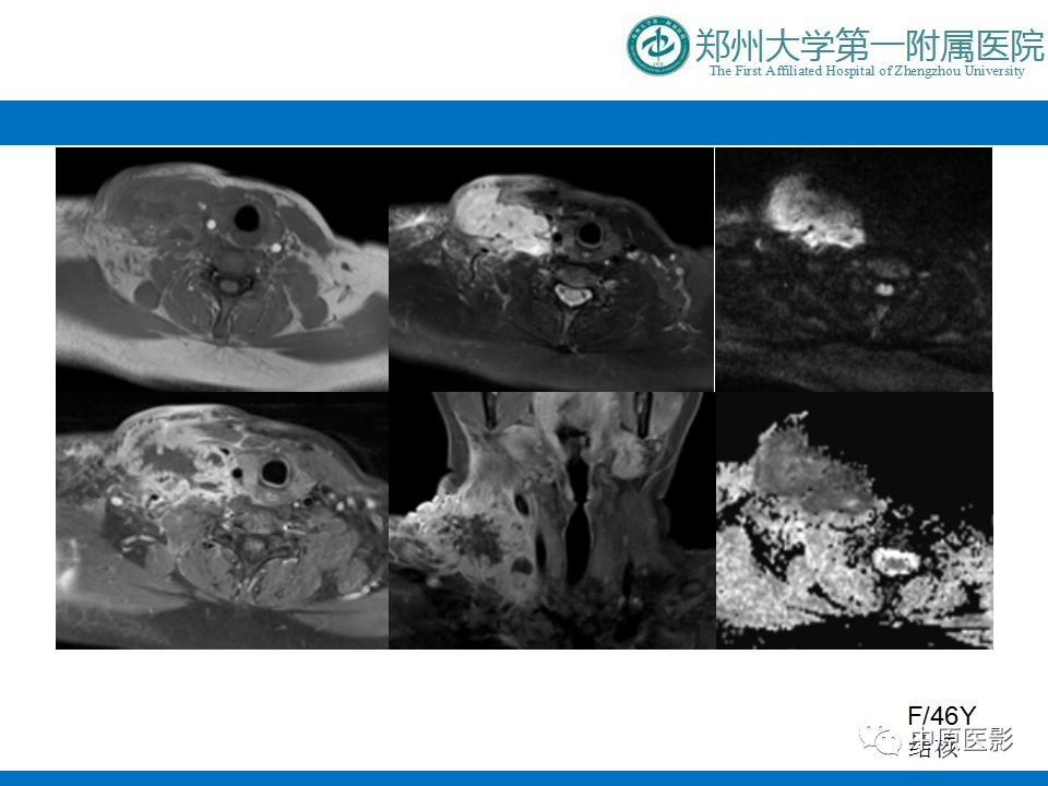 【PPT】颈部神经源性肿瘤的磁共振成像-35