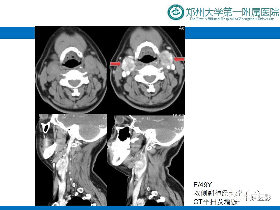 【PPT】颈部神经源性肿瘤的磁共振成像-41