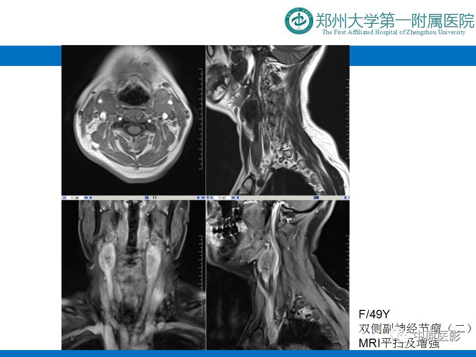 【PPT】颈部神经源性肿瘤的磁共振成像-42