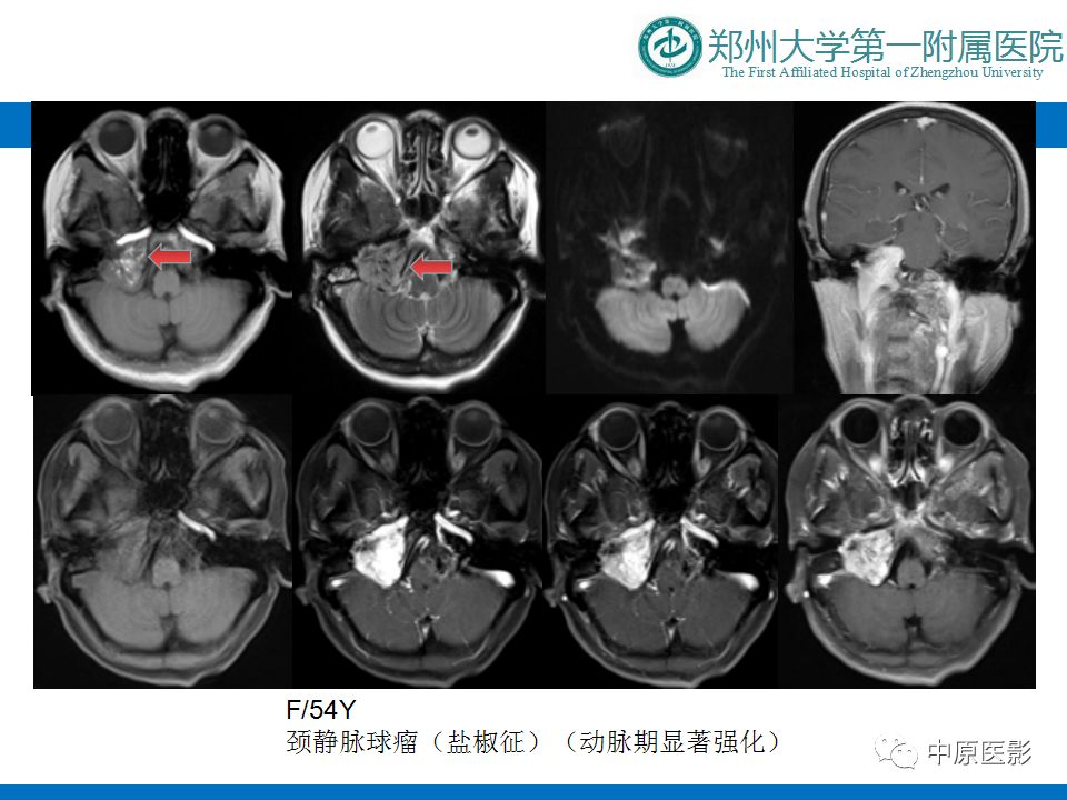 【PPT】颈部神经源性肿瘤的磁共振成像-46
