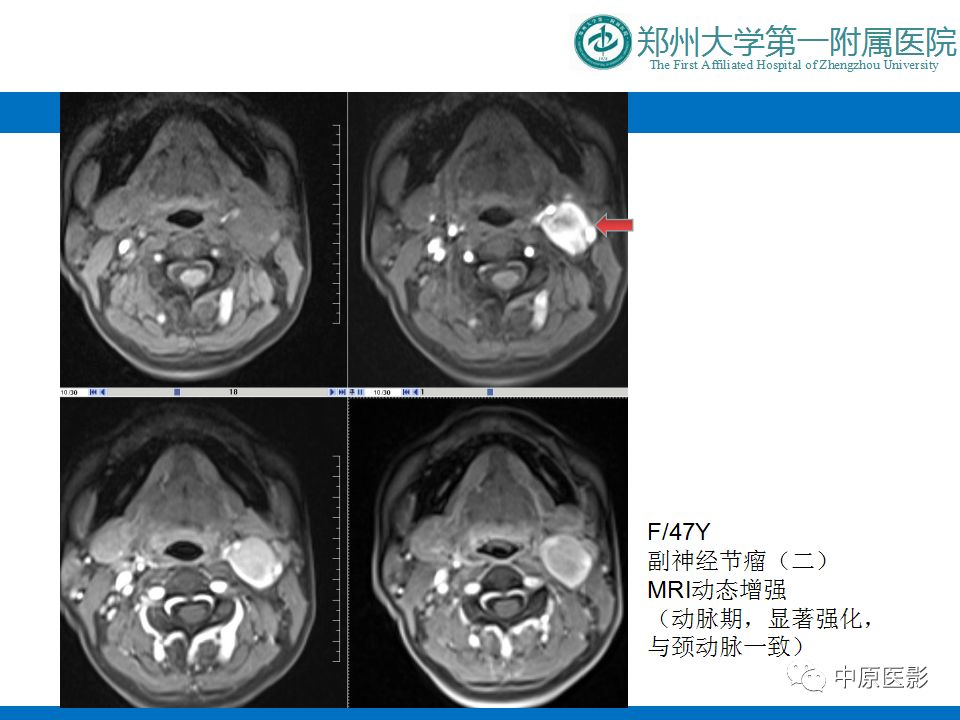 【PPT】颈部神经源性肿瘤的磁共振成像-45