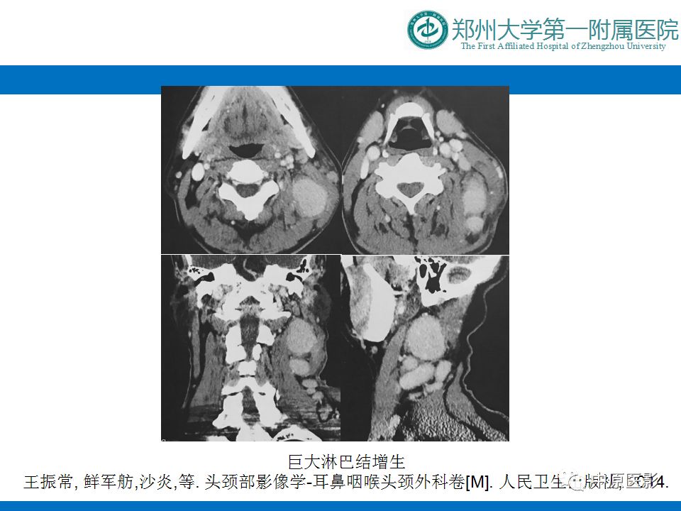 【PPT】颈部神经源性肿瘤的磁共振成像-50
