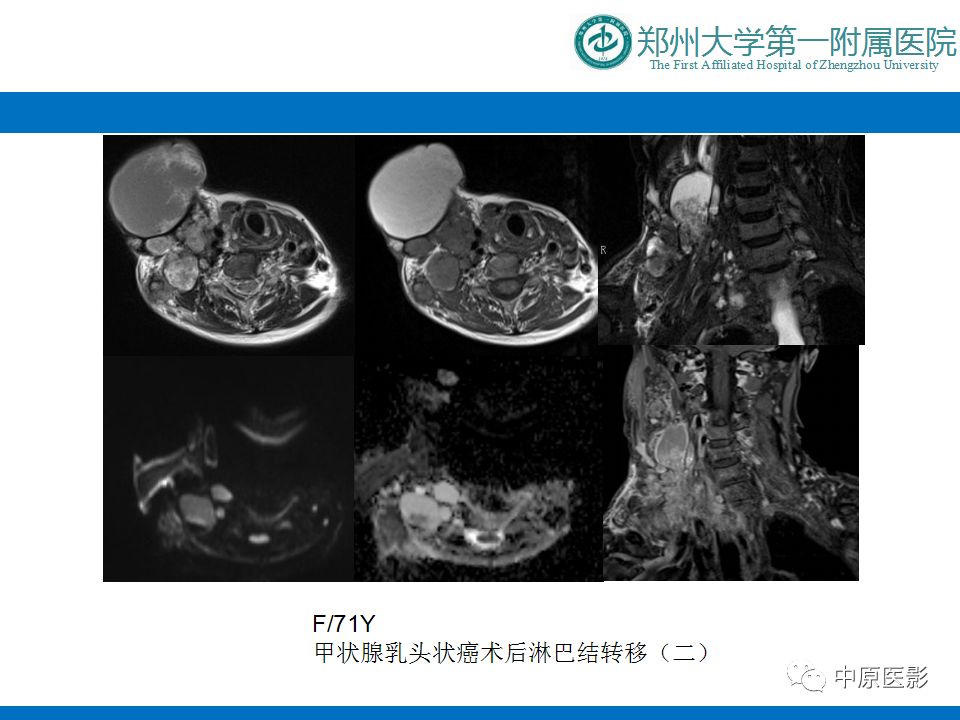 【PPT】颈部神经源性肿瘤的磁共振成像-52