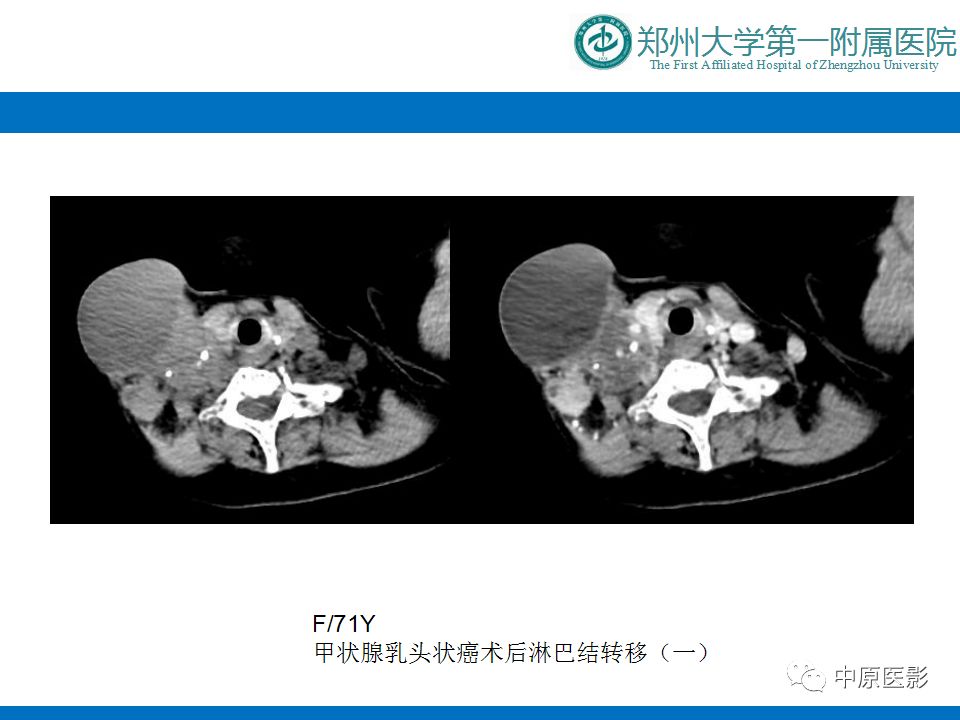 【PPT】颈部神经源性肿瘤的磁共振成像-51