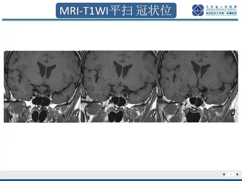 【PPT】垂体细胞瘤-4