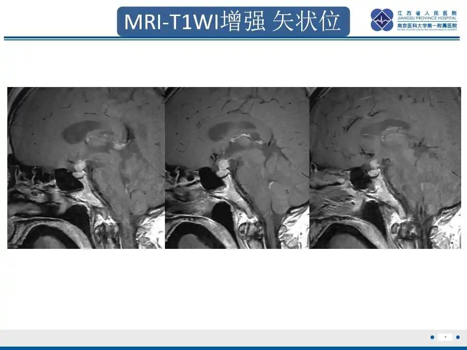 【PPT】垂体细胞瘤-8