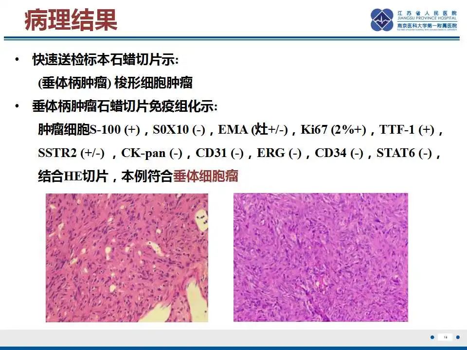 【PPT】垂体细胞瘤-19