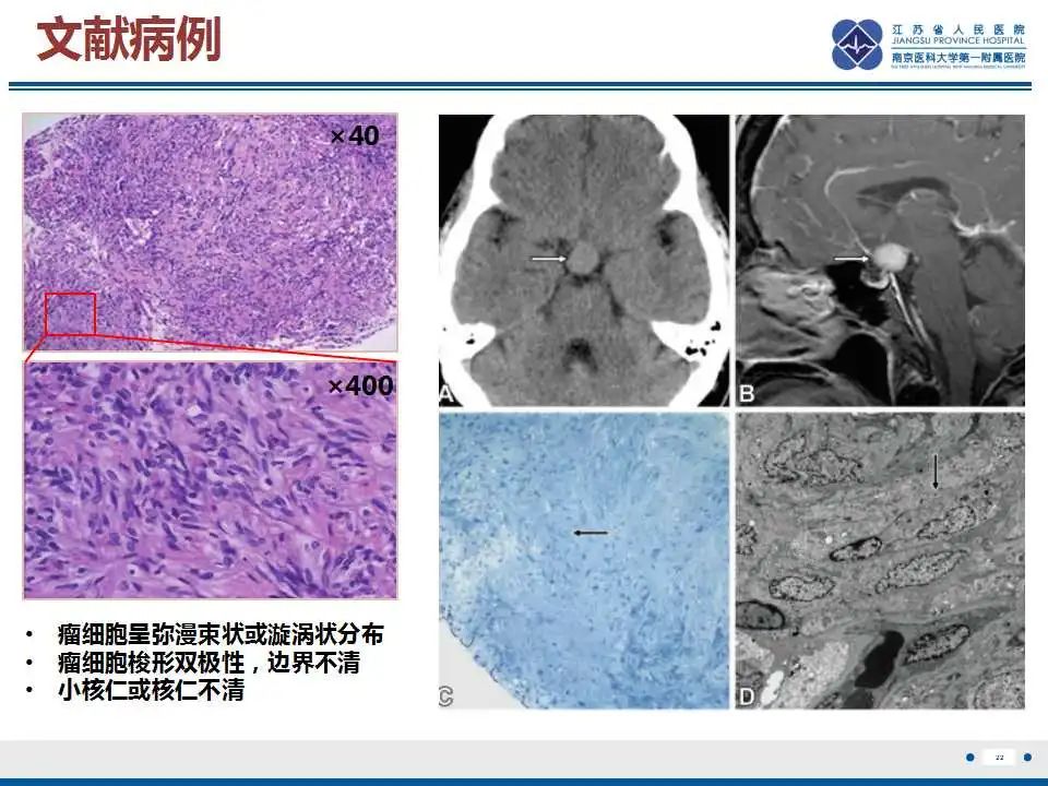 【PPT】垂体细胞瘤-23