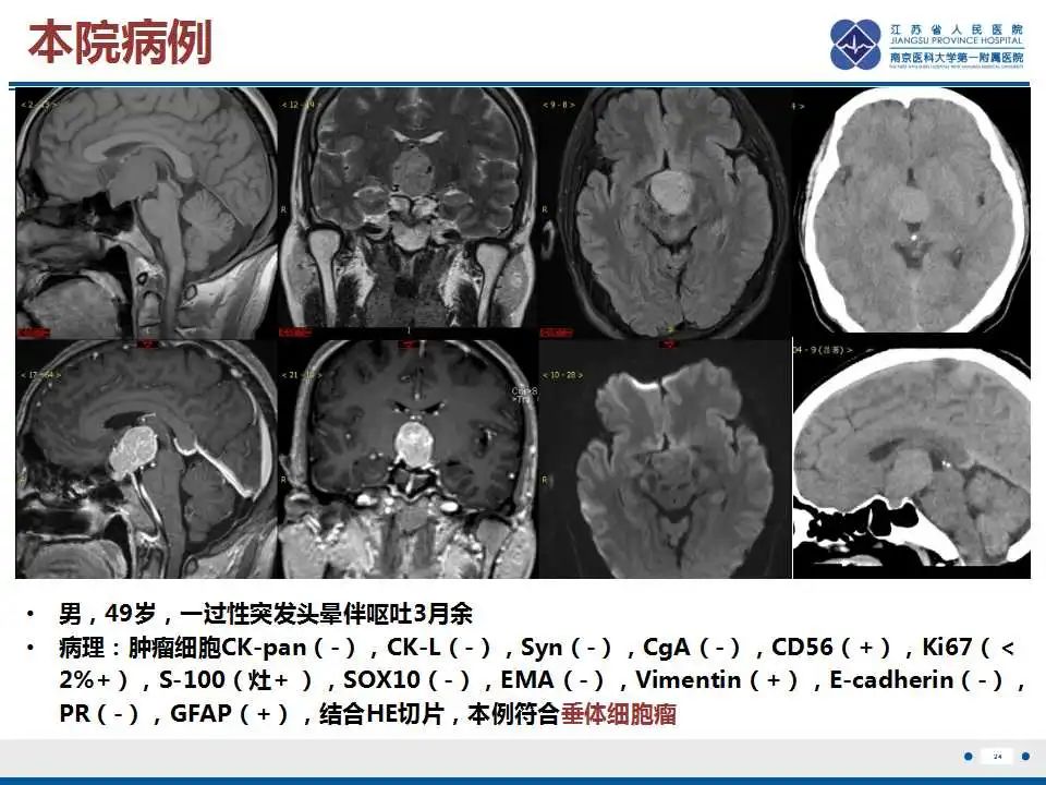 【PPT】垂体细胞瘤-25