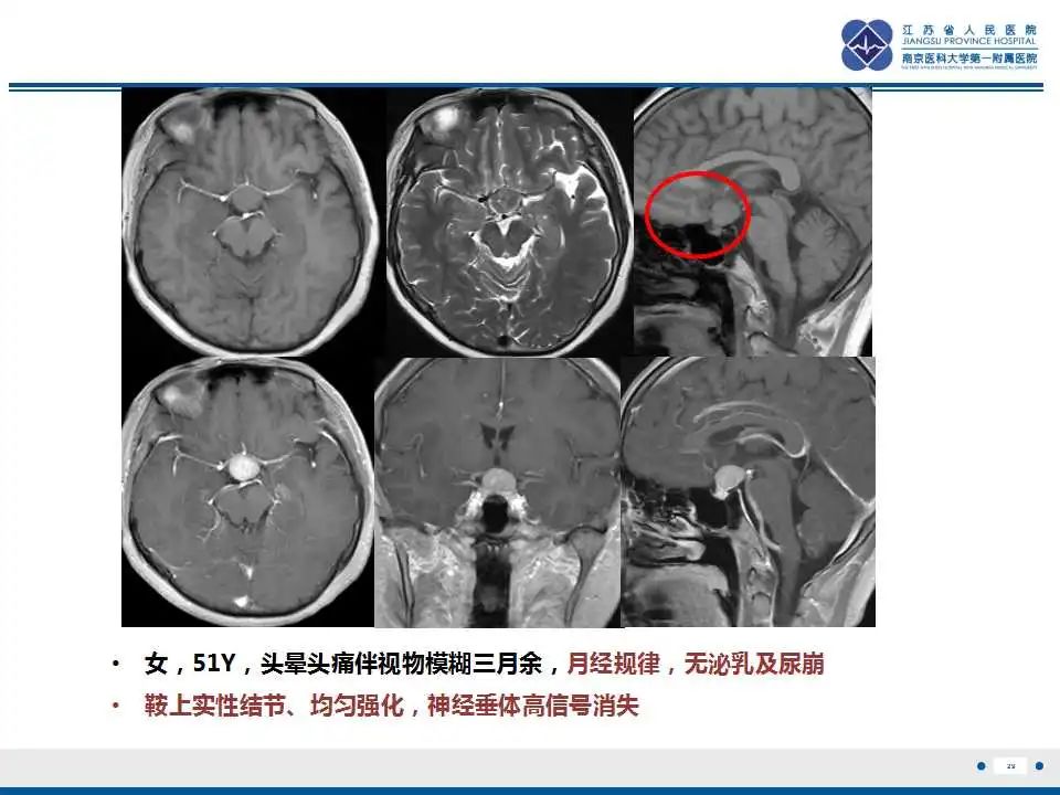 【PPT】垂体细胞瘤-30