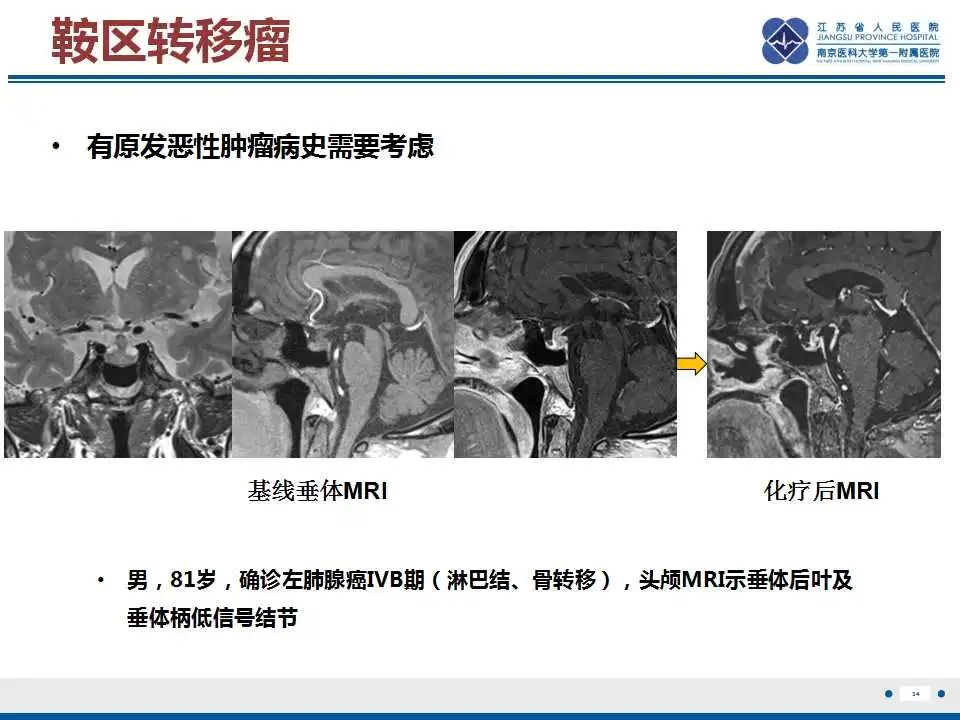 【PPT】垂体细胞瘤-35