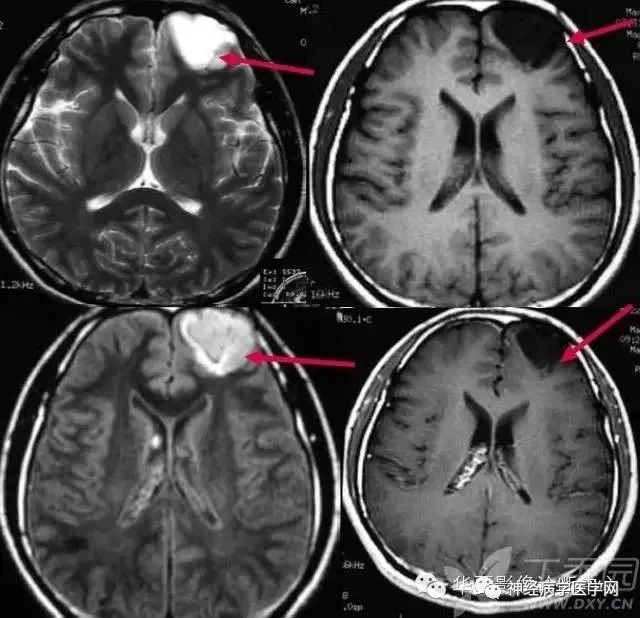 颅内肿瘤的“三角征”-1